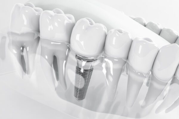 View from above of a false tooth implant fixed in the jawbone; 3D; 3D Illustration
